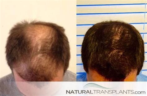 Regrow Hair Products | Hair Transplant Before and After | Hair doctor ...