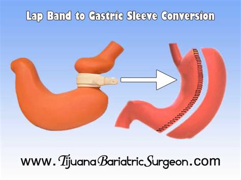 Lap Band to Gastric Sleeve in Mexico | Revision Gastric Banding ...