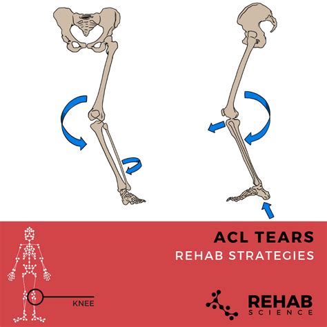 ACL Injury - Rehab Science