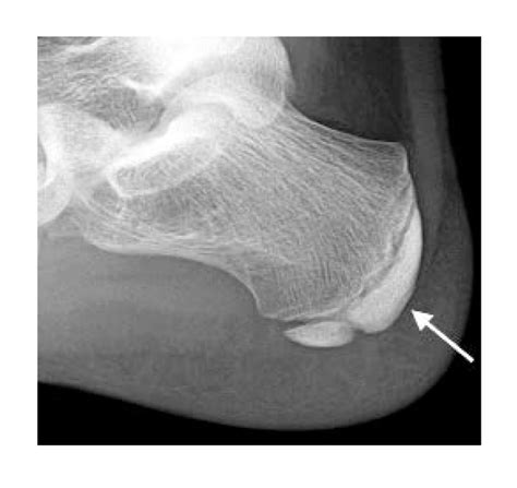 Sever Disease (Calcaneal Apophysitis)