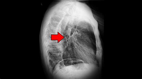 Esophagus Cancer Xray