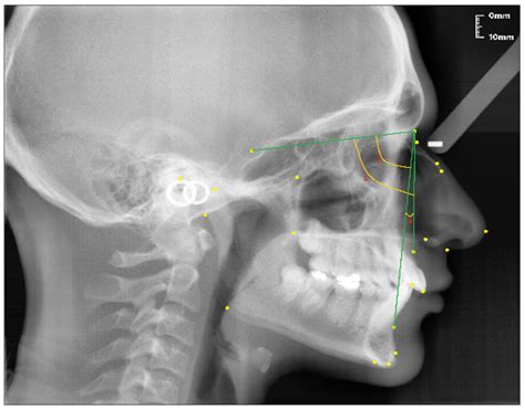 Nasal Bone X Ray Anatomy