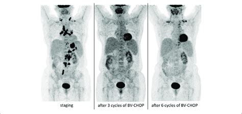 | PET/CT scan results of our patient with grey-zone lymphoma, who ...