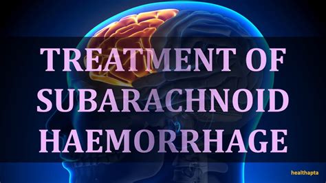 TREATMENT OF SUBARACHNOID HAEMORRHAGE - YouTube