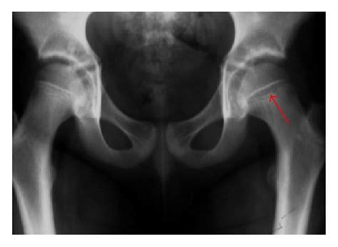 (a) X-ray of a 10-year-old child with left hip pain. It was considered ...