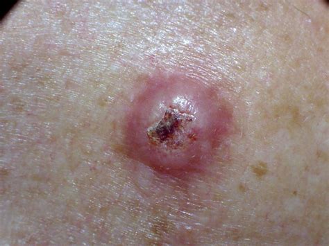 Squamous Cell Carcinoma: Symptoms, Causes, Treatment, & More