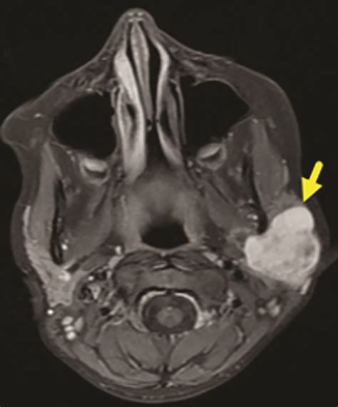 Pleomorphic Adenoma Mri