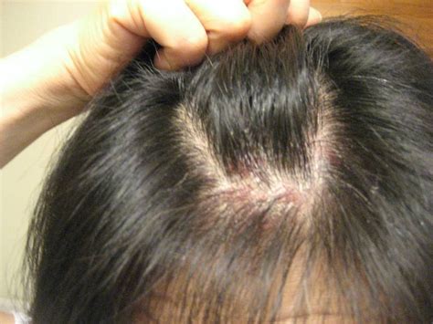 Understanding The Symptoms Of Skin & Scalp Psoriasis | Curly Chic