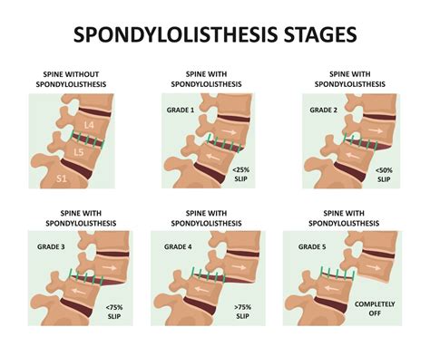 Spondylolisthesis Treatment In NJ | Comprehensive Spine Care