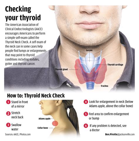 Thyroid Issues? Check Out Your Eyes!! - Really?? Yes + 'The Thyroid ...