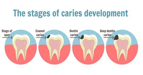 Avoid dental cavities with these tips - Algodones Dentists Guide