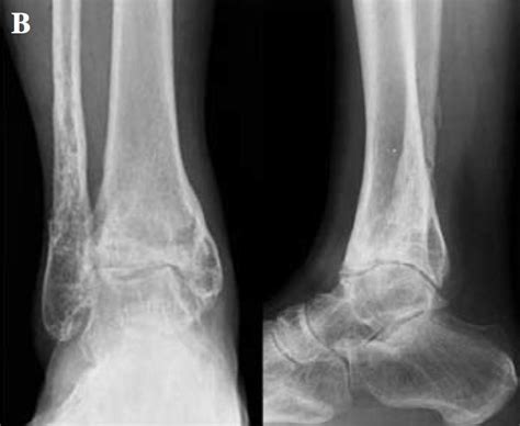 Ankle Arthrodesis - Foot & Ankle - Orthobullets