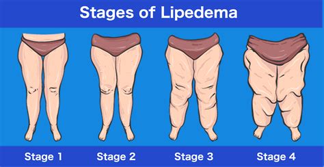 Stages of Lipedema - Pain & Swelling Solutions