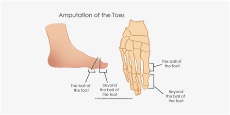 The Amputation Of The Toes 6 - Hallux Amputation Transparent PNG ...