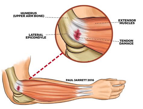 Epicondylitis - Dr Paul Jarrett, Orthopaedic Surgeon Perth