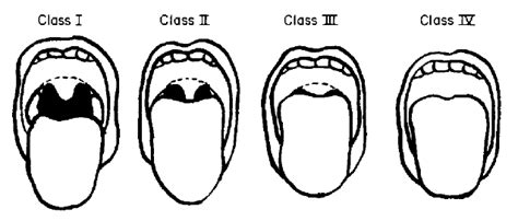 Mallampati Score • LITFL • Medical Eponym Library