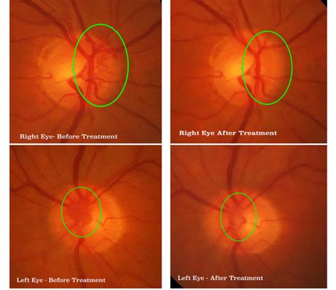 Proliferative Diabetic Retinopathy - Optic Disc Neovascularization ...