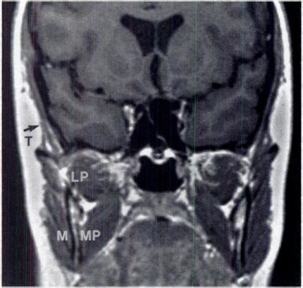 Coronal TI-weighted MR image demonstrates normal muscles of ...