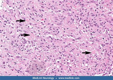 Pleomorphic xanthoastrocytoma | MedLink Neurology