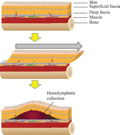 Illustration of Morel-Lavallée lesions. Tangential shearing force ...