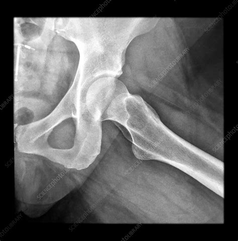 Hip Anatomy Radiology