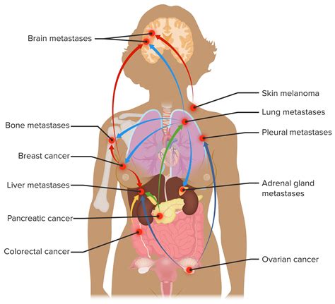 Grading, Staging, and Metastasis | Concise Medical Knowledge