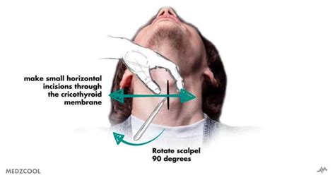 Emergency Cricothyroidotomy | Nucleotype