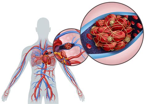 What Is a Pulmonary Embolism? | YourCareEverywhere