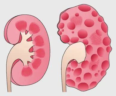 Polycystic Kidney Disease - Dr.Tathed's Homeopathy