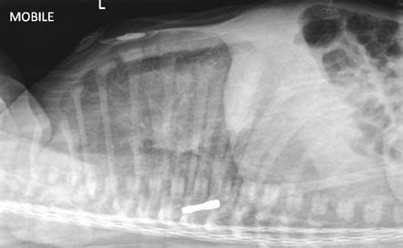 Pneumonia Lateral Chest X Ray