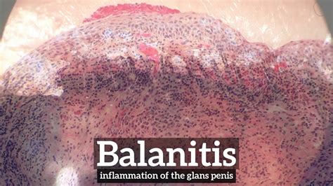 What is Balanitis? | How to Say Balanitis in English? | How Does ...