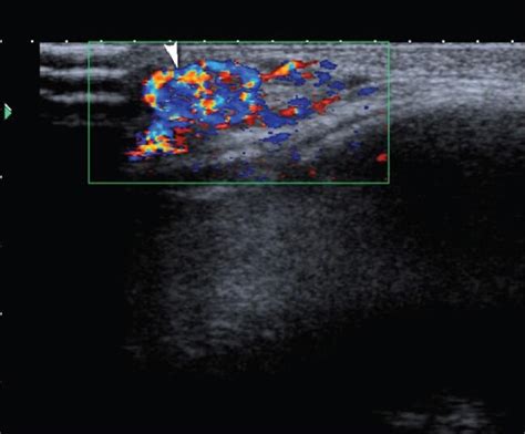 Hemangioma. Color Doppler image reveals a highly vascular mass ...