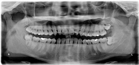 Dental Extractions and Wisdom Teeth | Seven Hills Dentist | Capstone Dental