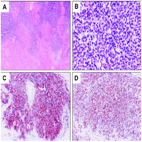 Ewing Sarcoma Histology