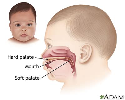 Cleft lip and palate Information | Mount Sinai - New York