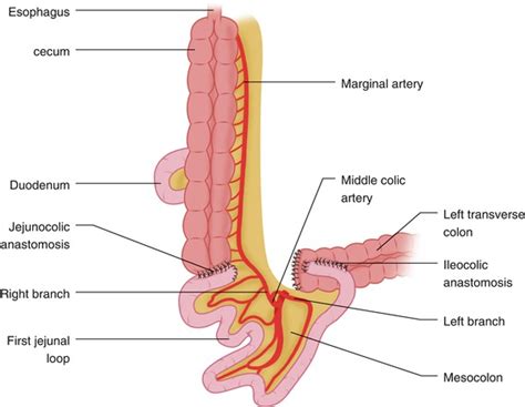 Colonic Interposition for Esophageal Replacement | Oncohema Key