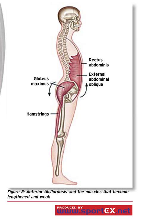 Anterior tilt/lordosis and the muscles that become lengthe… | Flickr