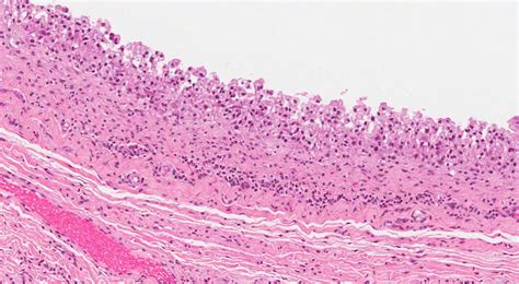 Mucocele Histology