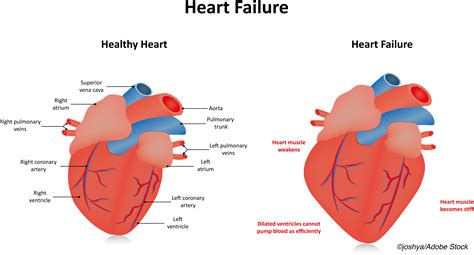 Incident Heart Failure: It’s Not Just LVEF Anymore - Physician's Weekly