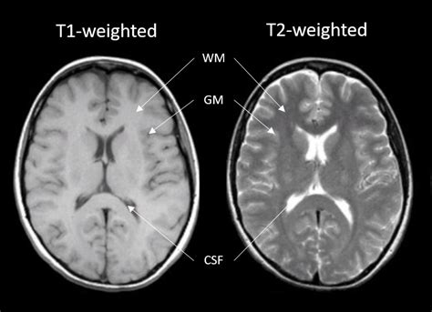 Magnetic Resonance Imaging