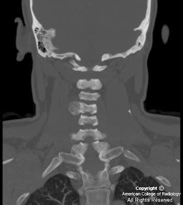 Neuroradiology On the Net: Osteoblastoma