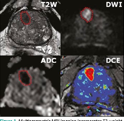 [PDF] Multiparametric MRI and targeted prostate biopsy: Improvements in ...