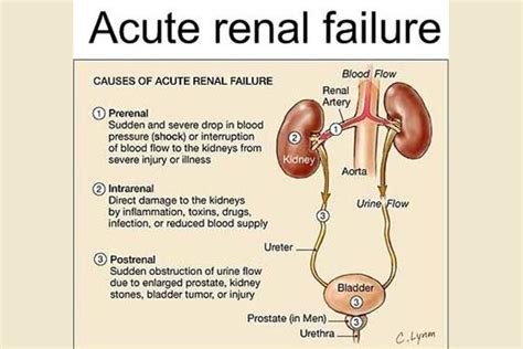 Acute renal failure – Dr. Ramesh Juvekar – Urologist, Andrologist ...