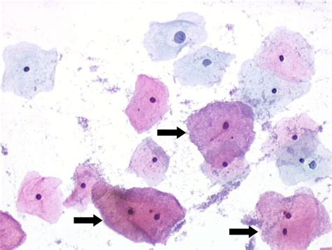 Gardnerella vaginalis: bacteria are seen in the background, mainly ...