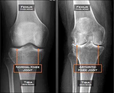 Osteoarthritis - Causes, Symptoms, Diagnosis, Prognosis & Treatment