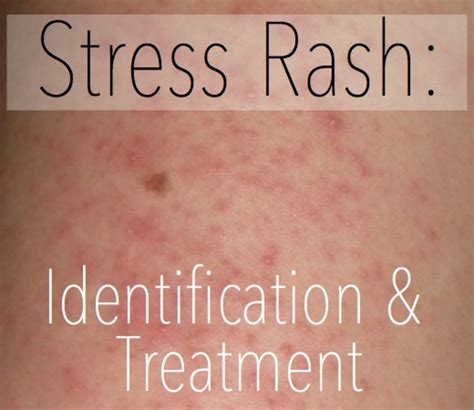 Stress Rash: Causes, Symptoms, Pictures, & Treatment | HubPages