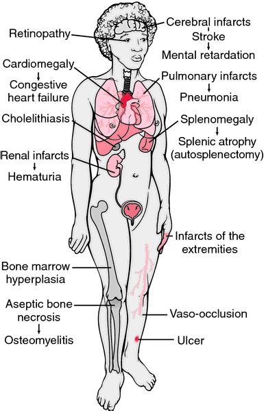 Describe the Symptoms of Sickle Cell Anemia - HarrykruwPerez