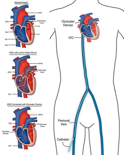 Transcatheter Occluder Devices for the Closure of Atrial Septal Defect ...