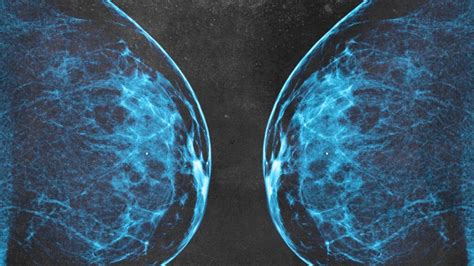 3D mammogram: Who needs one, what to expect, and risks