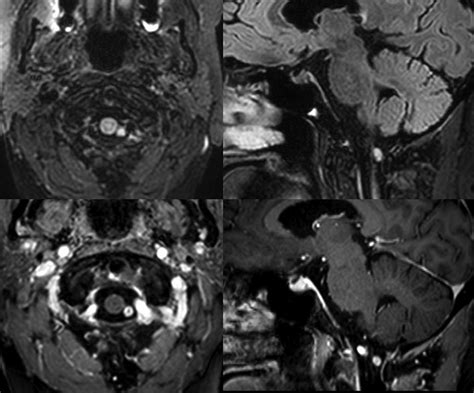 Foramen Magnum Mri